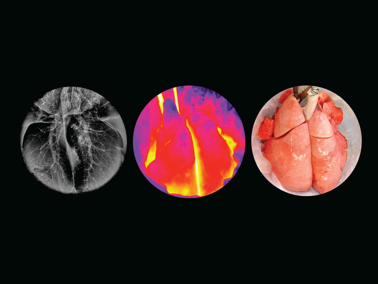 Recovering injured lungs with cross-circulation